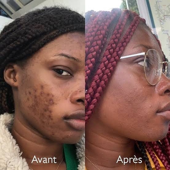 Le Savon anti - taches au curcuma | 100% Naturel (GN)